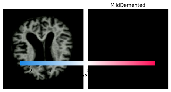 SHAP for classification
